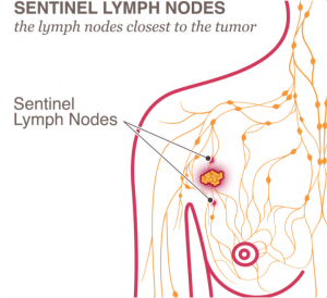 Sentinel Lymph Nodes